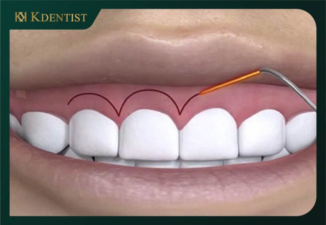 cắt lợi bằng laser bao nhiêu tiền cắt lợi bằng laser bao nhiêu tiền