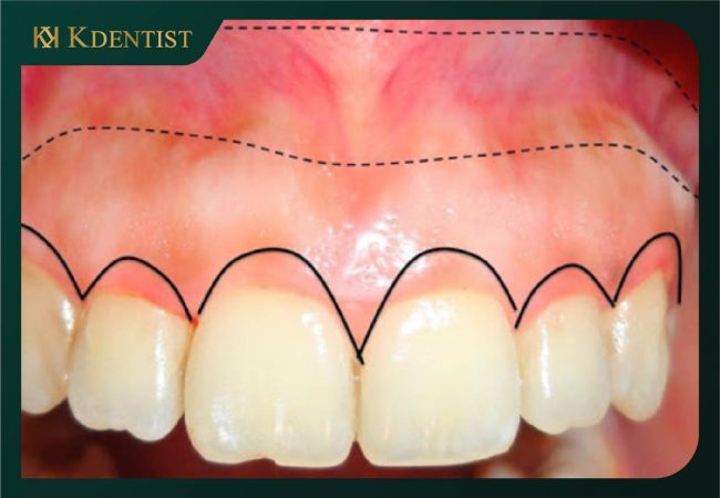Trường hợp cắt nướu cần chỉnh xương ổ răng Trường hợp cắt nướu cần chỉnh xương ổ răng