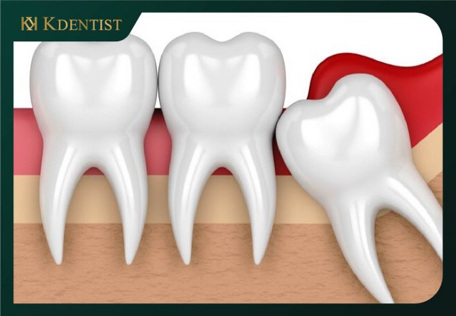 Cắt lợi trùm răng khôn là gì Cắt lợi trùm răng khôn là gì