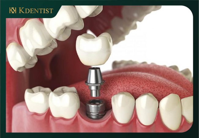 Công nghệ chế tạo trụ implant Công nghệ chế tạo trụ implant