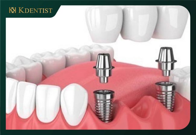 Răng trụ implant Neodent Thụy Sĩ Răng trụ implant Neodent Thụy Sĩ