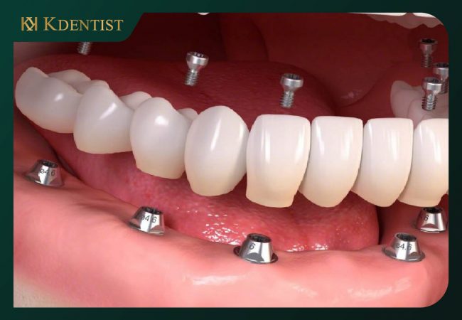 Nên niềng răng trước hay trồng răng implant trước Nên niềng răng trước hay trồng răng implant trước