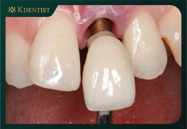 Cấy ghép implant hạn chế tình trạng tiêu xương hàm Cấy ghép implant hạn chế tình trạng tiêu xương hàm