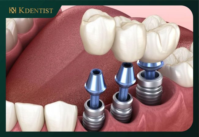 Vật liệu chế tạo trụ implant bằng titanium Vật liệu chế tạo trụ implant bằng titanium