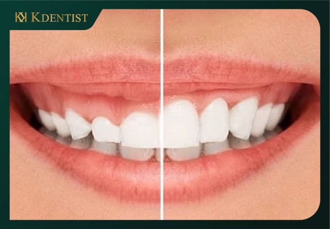 Lợi ích của phương pháp cắt lợi laser Lợi ích của phương pháp cắt lợi laser