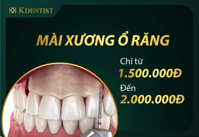 Giá mài xương ổ răng hiện nay Giá mài xương ổ răng hiện nay