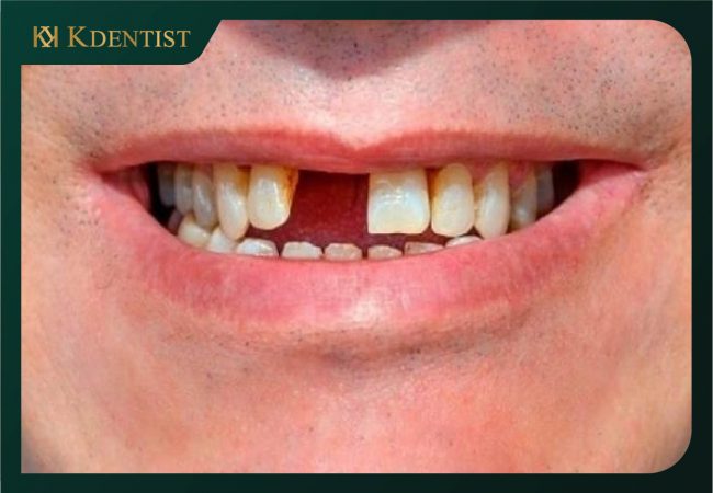 Tình trạng mất răng Tình trạng mất răng