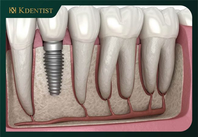 Răng trụ implant Straumann Thụy sỹ Răng trụ implant Straumann Thụy sỹ