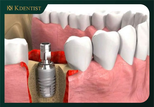 Răng trụ implant Mis C1 Đức Răng trụ implant Mis C1 Đức