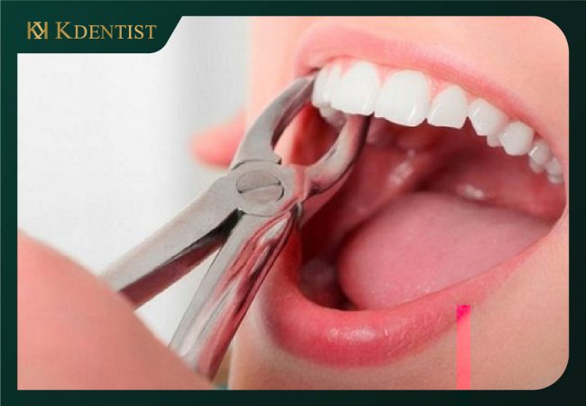 Dịch vụ nhổ răng không đau tại Quảng Ngãi của HH DENTAL Dịch vụ nhổ răng không đau tại Quảng Ngãi của HH DENTAL