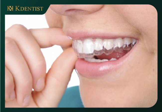 Niềng răng 1 hàm mất bao lâu Niềng răng 1 hàm mất bao lâu