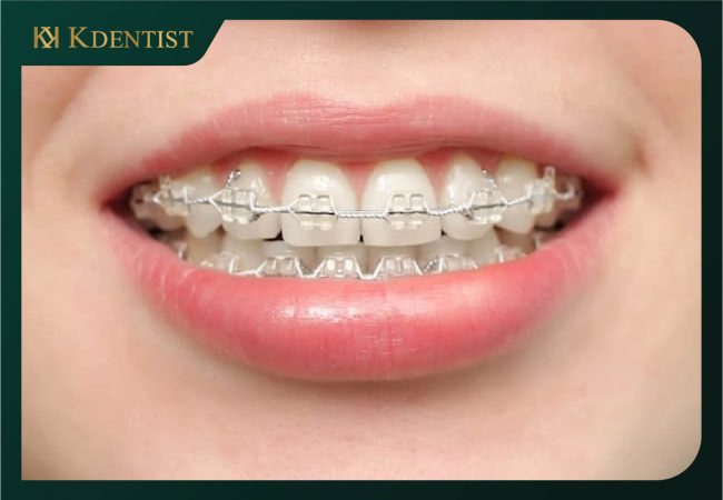 lưu ý chế độ ăn uống sau khi niềng răng lưu ý chế độ ăn uống sau khi niềng răng
