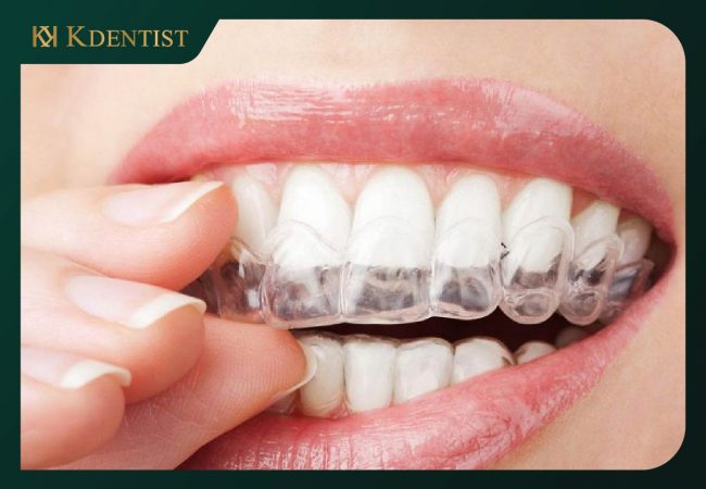 Phương pháp niềng răng không mắc cài Invisalign Phương pháp niềng răng không mắc cài Invisalign