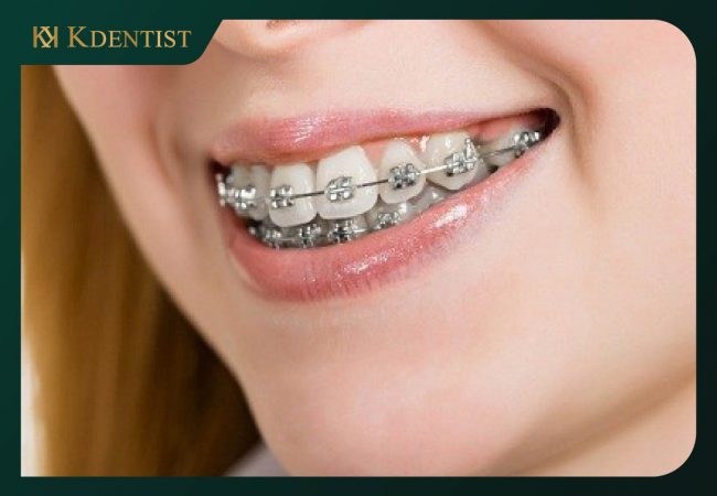 Có nên thực hiện niềng răng hô nhẹ Có nên thực hiện niềng răng hô nhẹ