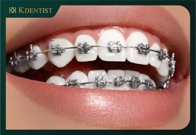 Niềng răng với mắc cài kim loại Niềng răng với mắc cài kim loại