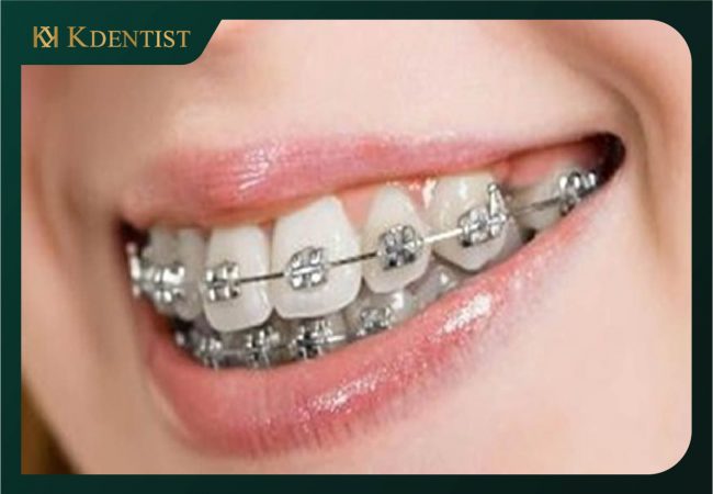 Niềng răng - Giải giáp cải thiện răng thưa Niềng răng - Giải giáp cải thiện răng thưa