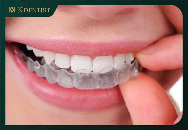 25 Tuổi niềng răng mất bao lâu 25 Tuổi niềng răng mất bao lâu