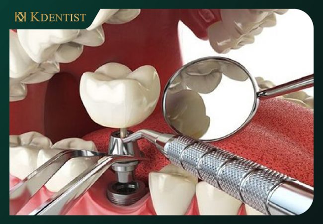 Sau khi trồng răng implant bao lâu thì ăn được Sau khi trồng răng implant bao lâu thì ăn được