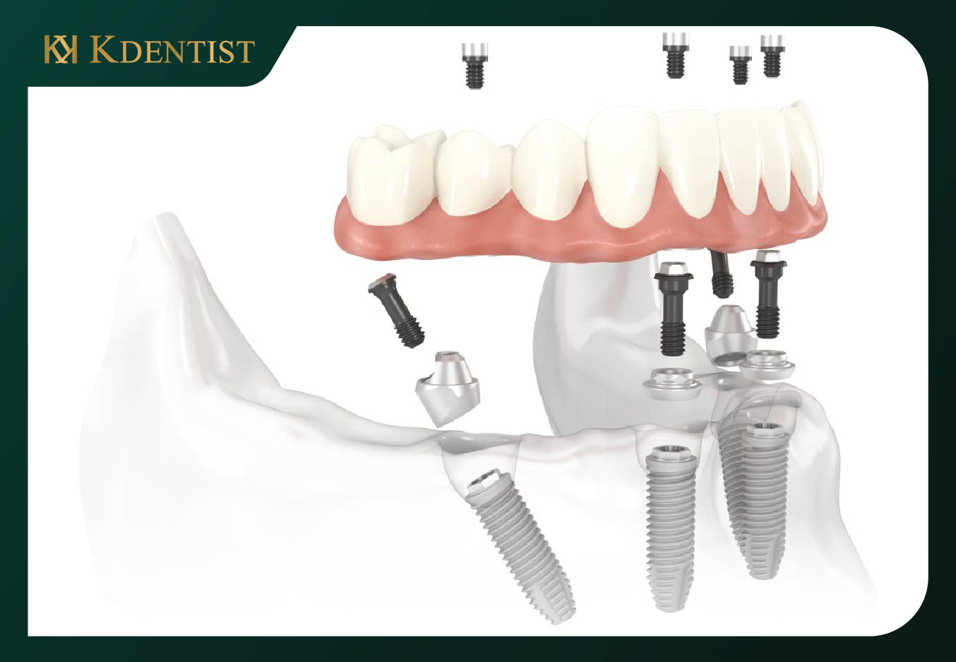 cấy ghép implant all on 4