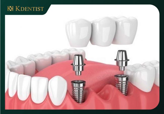 Trồng răng implant Trồng răng implant