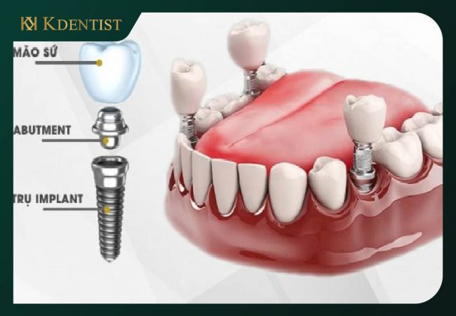Trường hợp trồng răng và niềng răng được Trường hợp trồng răng và niềng răng được