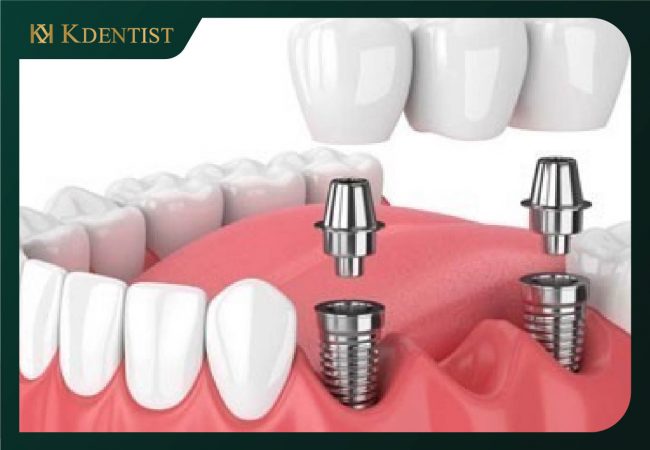 Chất lượng của trụ răng implant Chất lượng của trụ răng implant