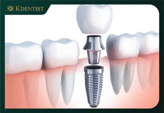 Răng trụ implant Osstem Hàn Quốc Răng trụ implant Osstem Hàn Quốc