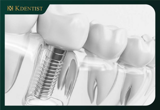 Răng trụ implant Hiossen Mỹ Răng trụ implant Hiossen Mỹ