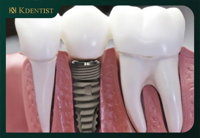 Răng trụ implant Biotem Hàn Quốc Răng trụ implant Biotem Hàn Quốc