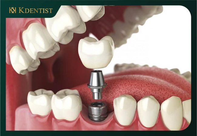 Tuổi thọ của phương pháp trồng răng implant Tuổi thọ của phương pháp trồng răng implant