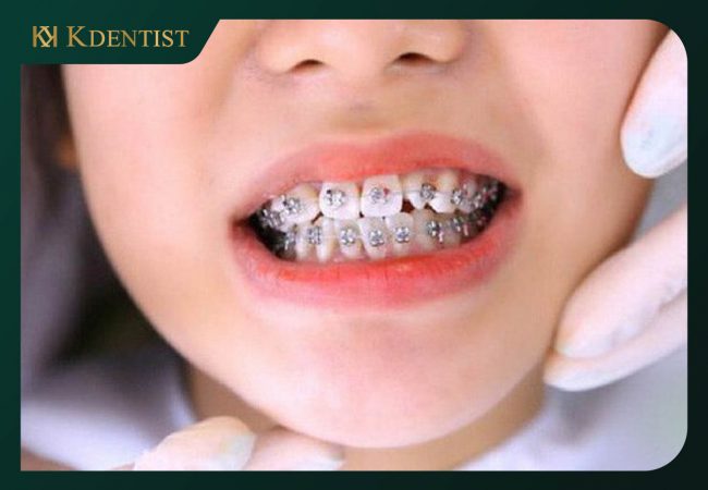 Trồng răng implant có niềng răng được không Trồng răng implant có niềng răng được không