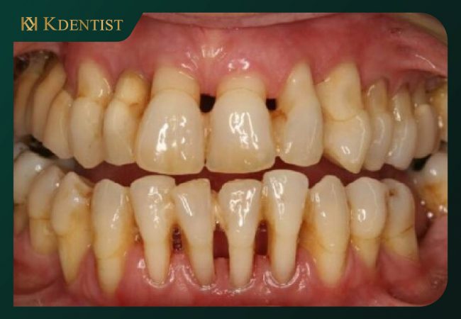 Gây ra nhiều bệnh lý răng miệng khác Gây ra nhiều bệnh lý răng miệng khác
