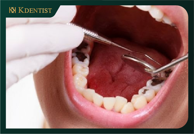 Nguyên tắc chữa viêm tủy răng cho bà bầu Các lưu ý khi đặt thuốc chữa tủy răng
