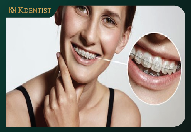 niềng răng ở tuổi 30 có nên hay không