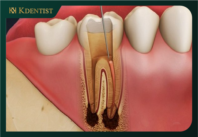 Điều trị tủy răng có nguy hiểm không Điều trị tủy răng có nguy hiểm không