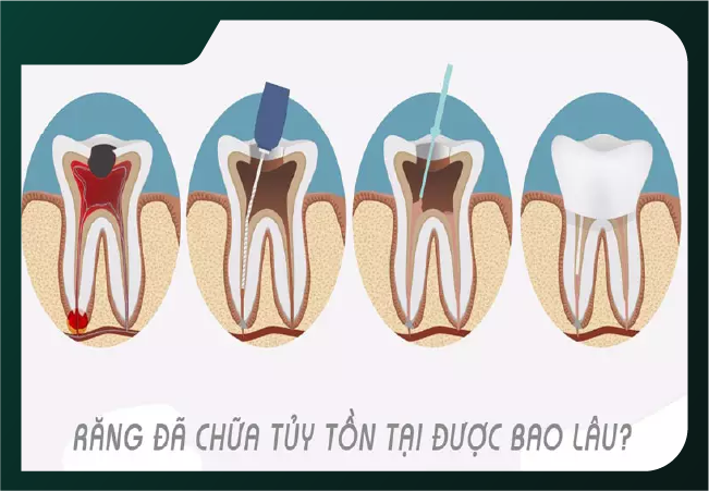 Răng chữa tủy tồn tại được bao lâu Răng chữa tủy tồn tại được bao lâu