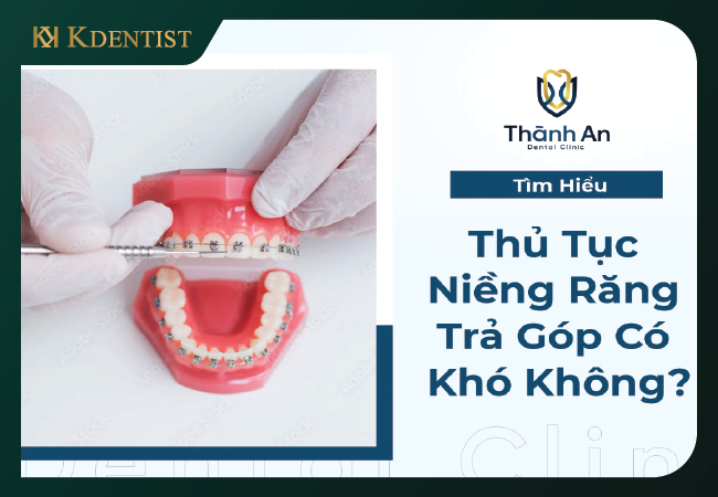 Tìm hiểu kỹ thông tin trả góp tại nha khoa Tìm hiểu kỹ thông tin trả góp tại nha khoa